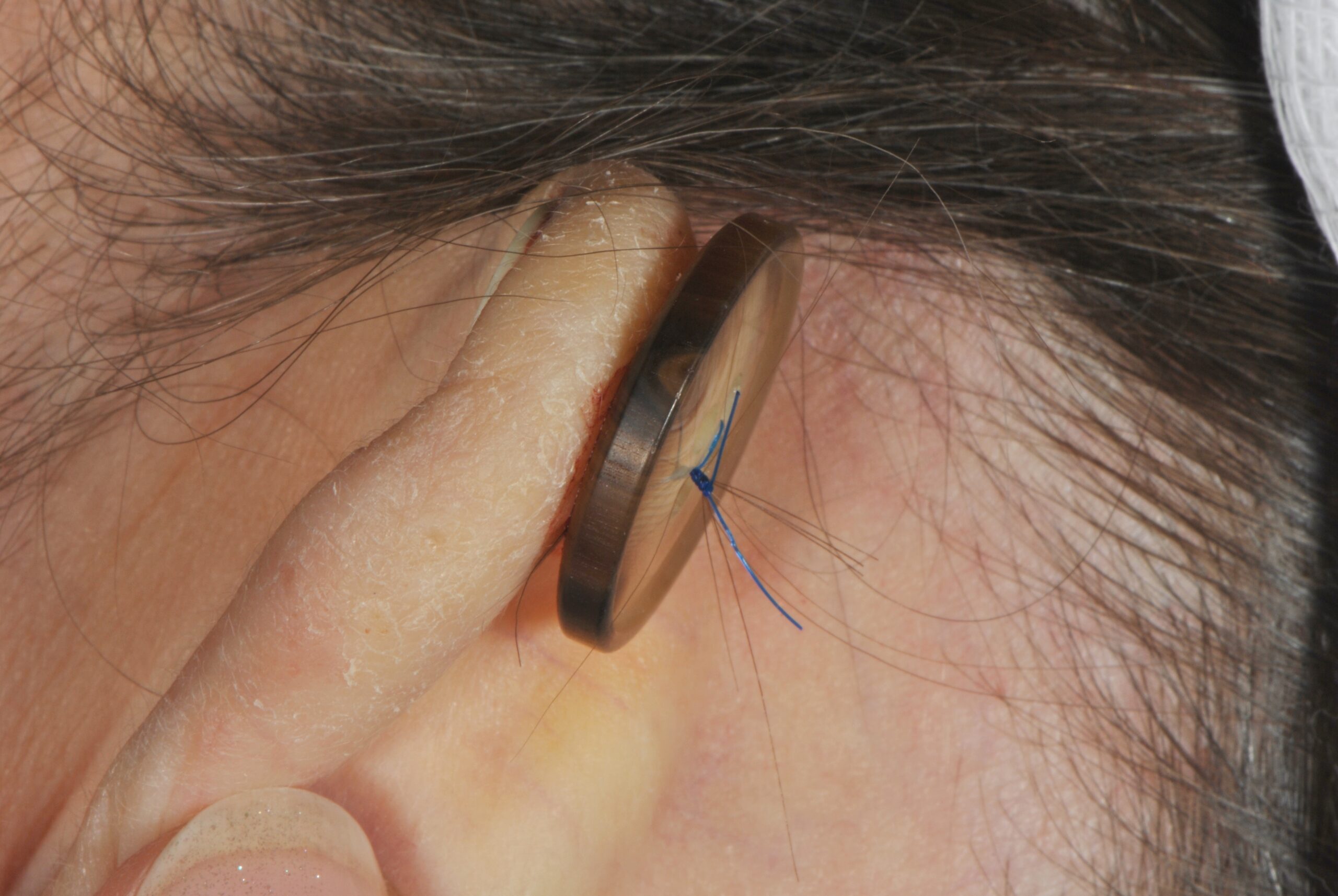 Auricular Pseudocyst