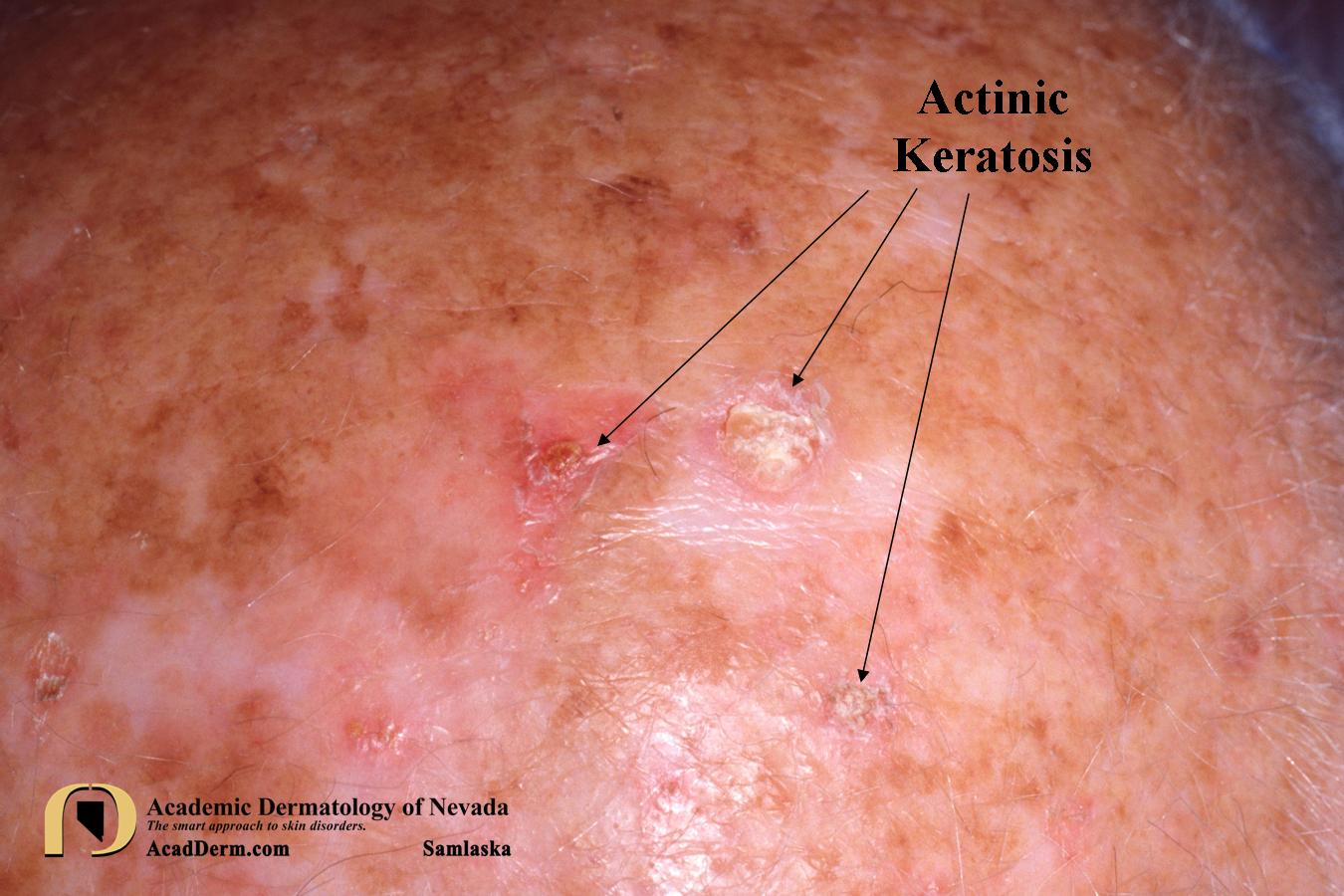 Actinic Keratosis:  What is it?
