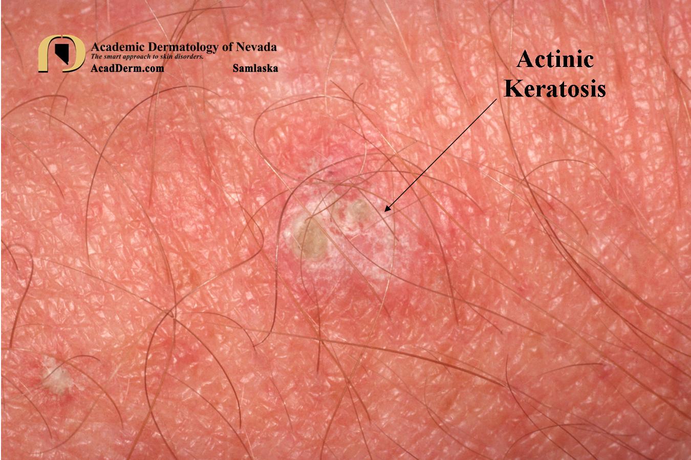 Actinic Keratosis:  Why does Dr. Samlaska freeze so much…