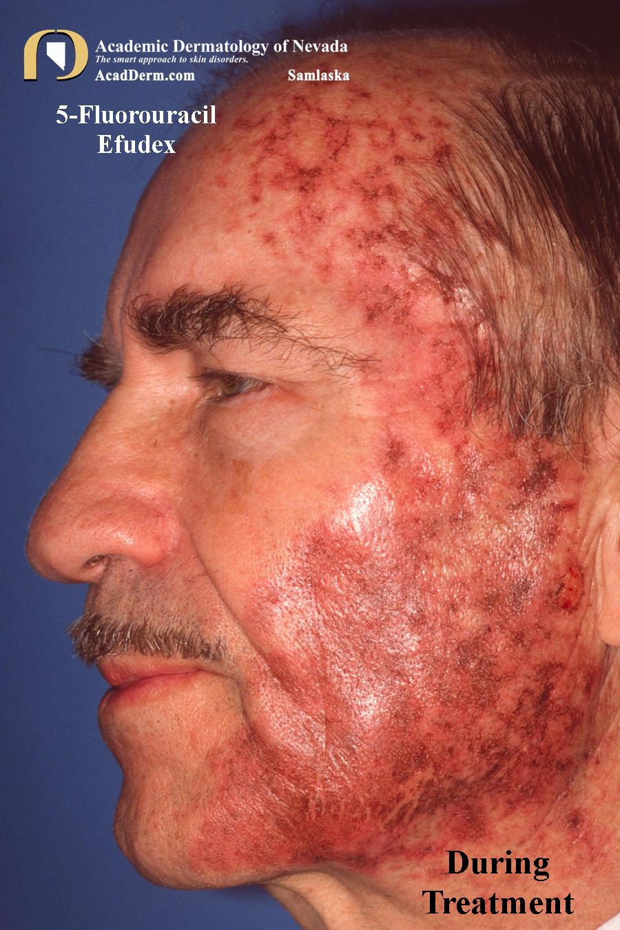 Actinic Keratosis:  Field Treatments—5-Fluorouracil, Imiquimod, Ingenol and Photodynamic Therapy (PDT)