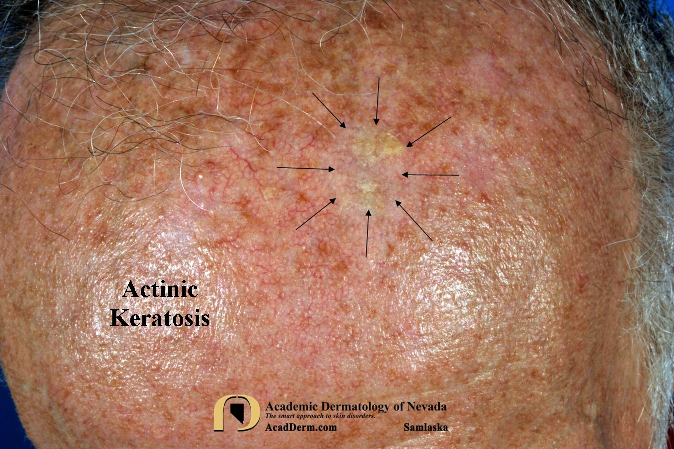 Actinic Keratosis:  Treatment—Cryotherapy