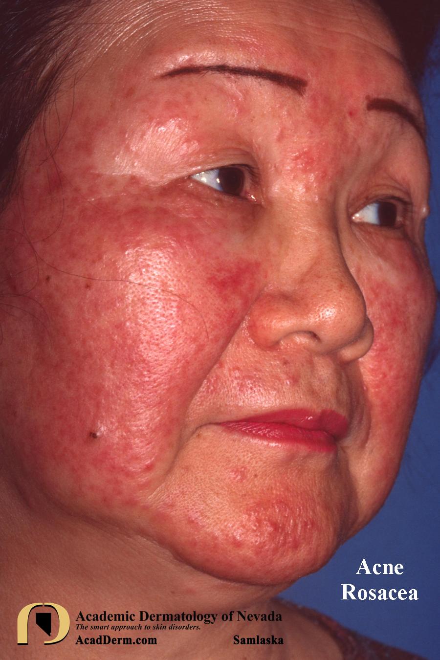 Acne Rosacea