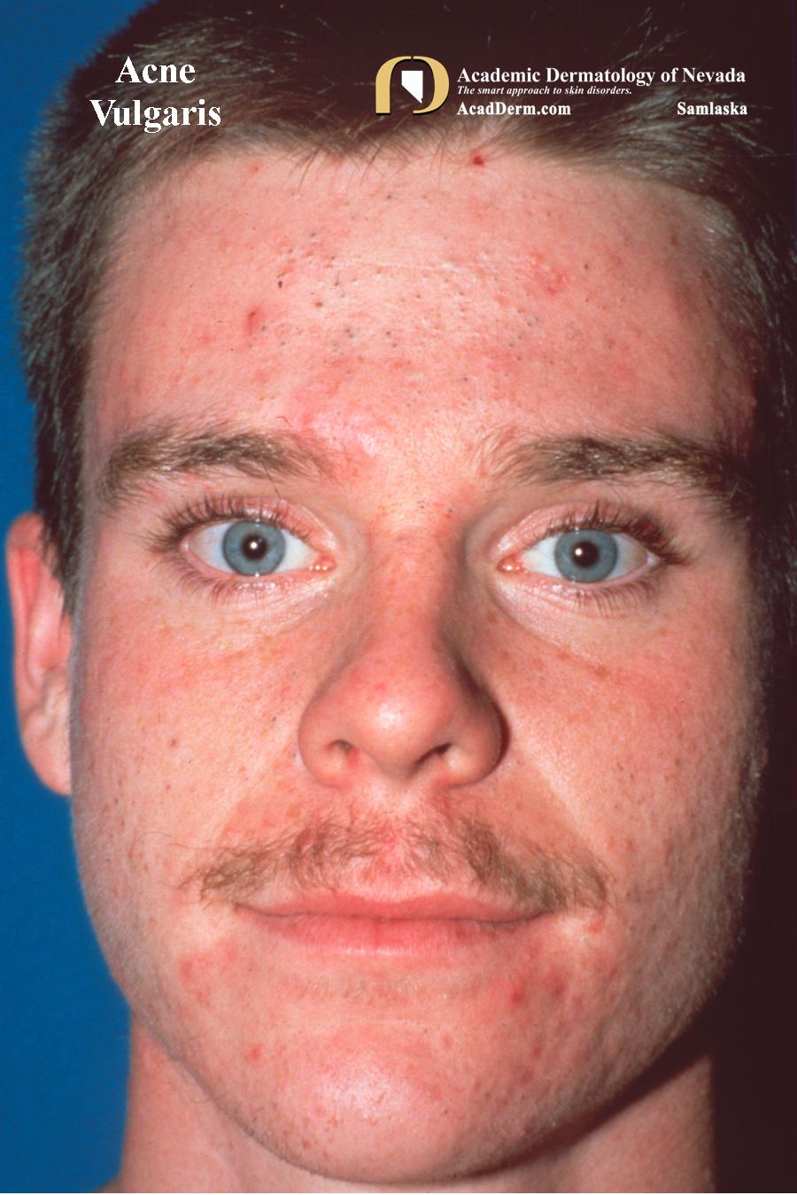 Acne Vulgaris:  The Good, the Bad and the Scarring…