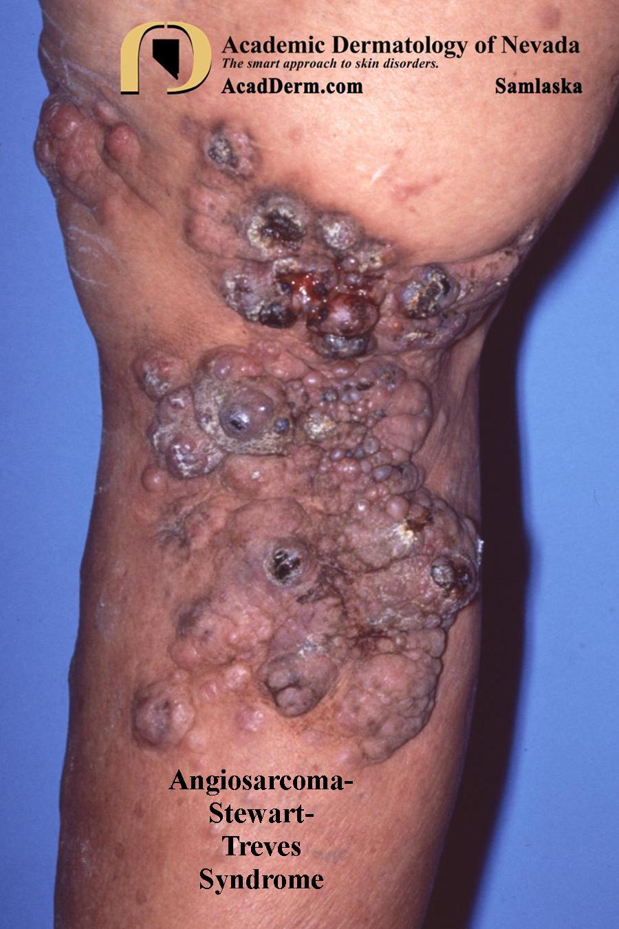 Angiosarcoma–Stewart-Treves Syndrome
