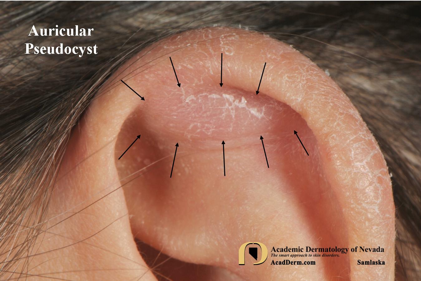 Auricular Pseudocyst:  Treating with buttons