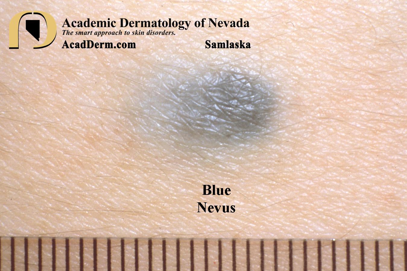 Blue Nevus