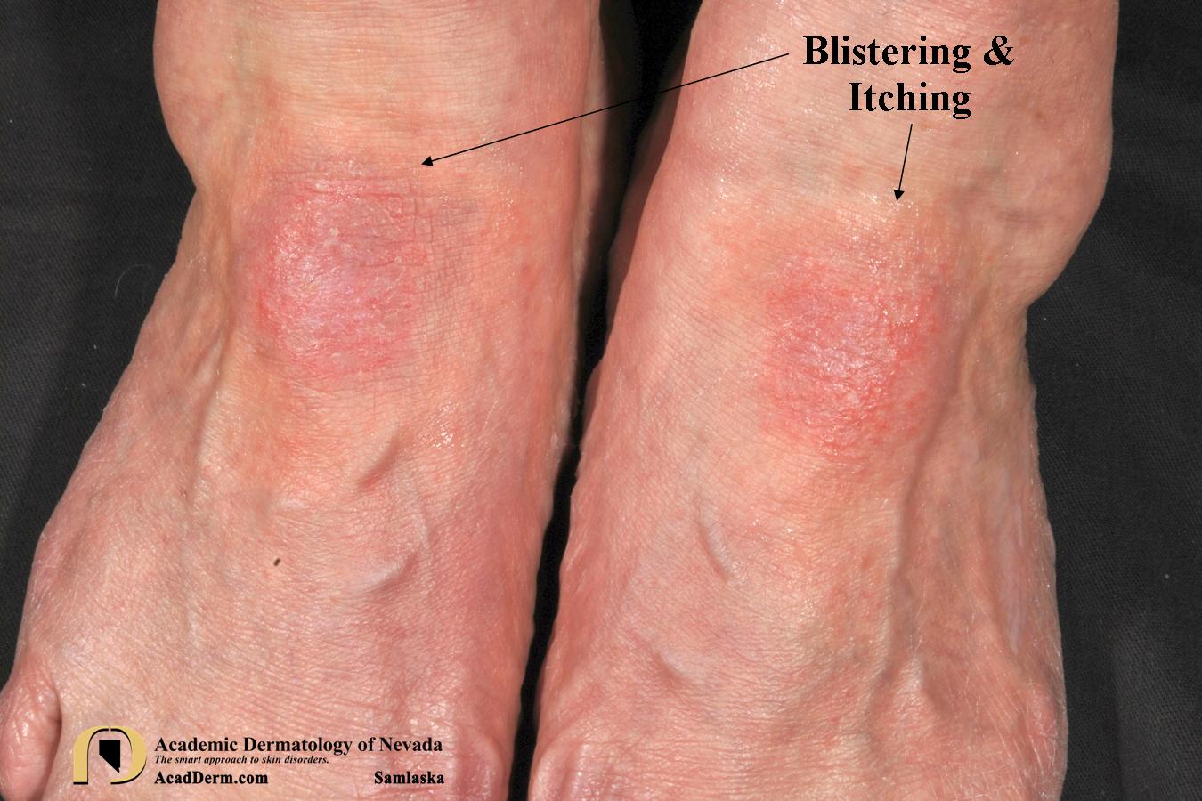 Dermatology Detective…Contact Dermatitis