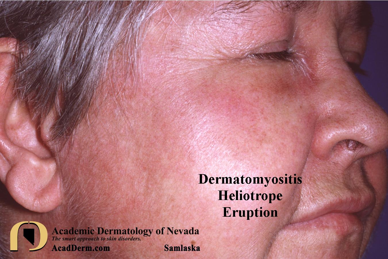 Dermatomyositis