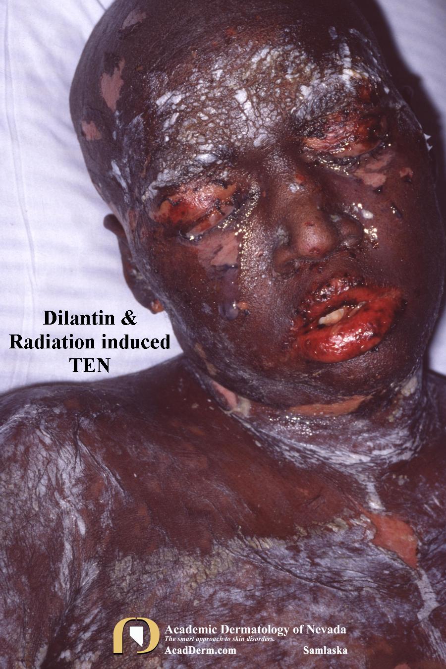 Drug Eruptions:  Dilantin & Radiation Associated TEN