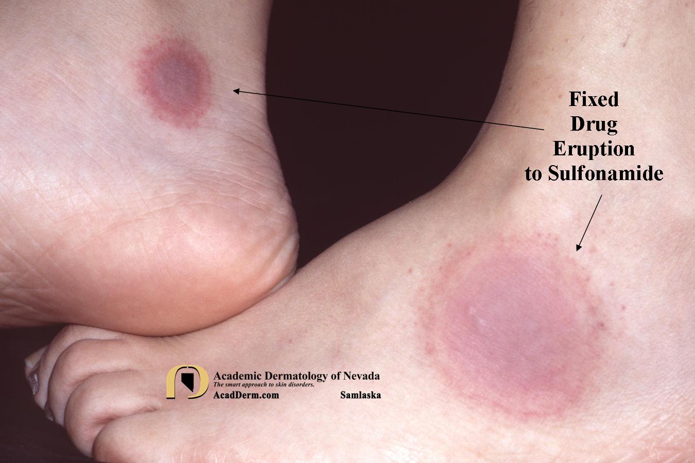 Drug Eruptions:  Fixed Drug Eruptions
