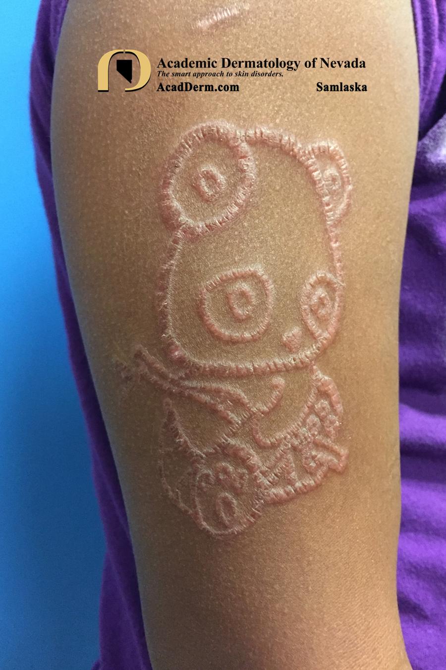 Contact Dermatitis:  Henna Tattoos