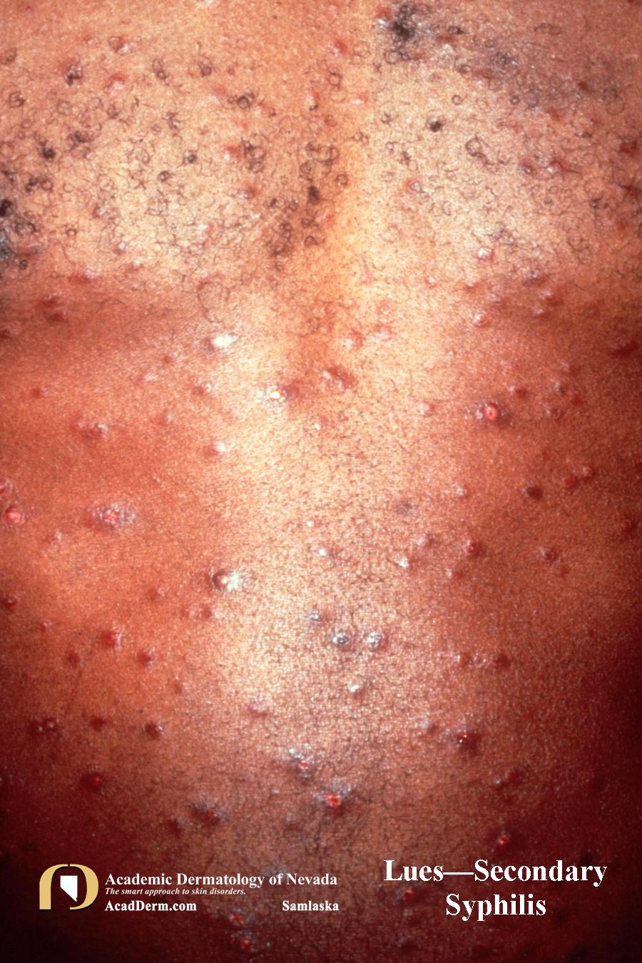 Secondary Syphilis (Lues):  It looks like Pityriasis Rosea…but it’s not…