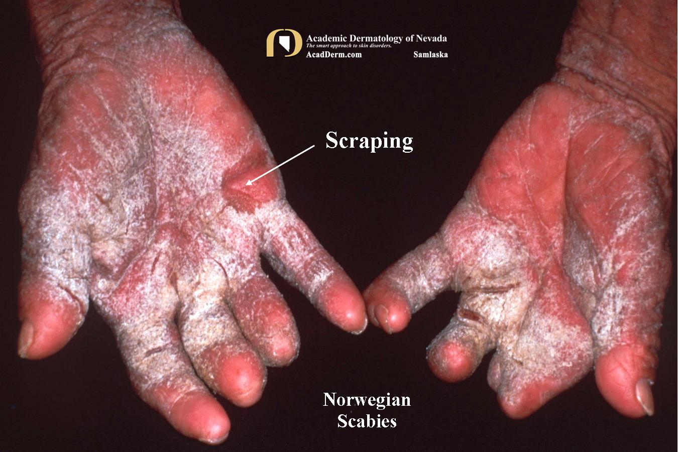 Parasitic Diseases:  Norwegian Scabies…a closer look…