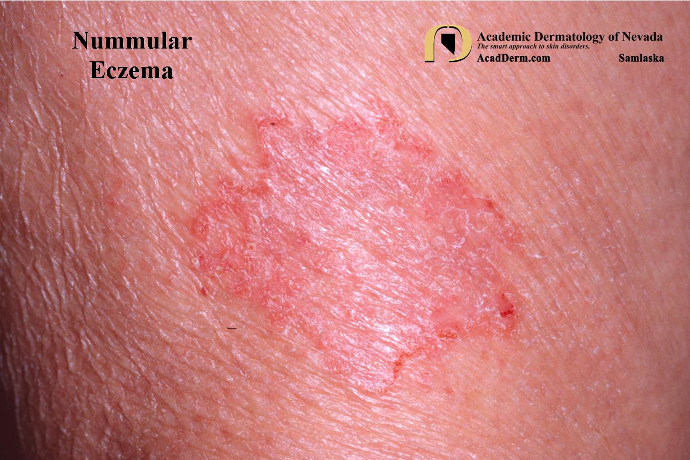 Nummular Eczema