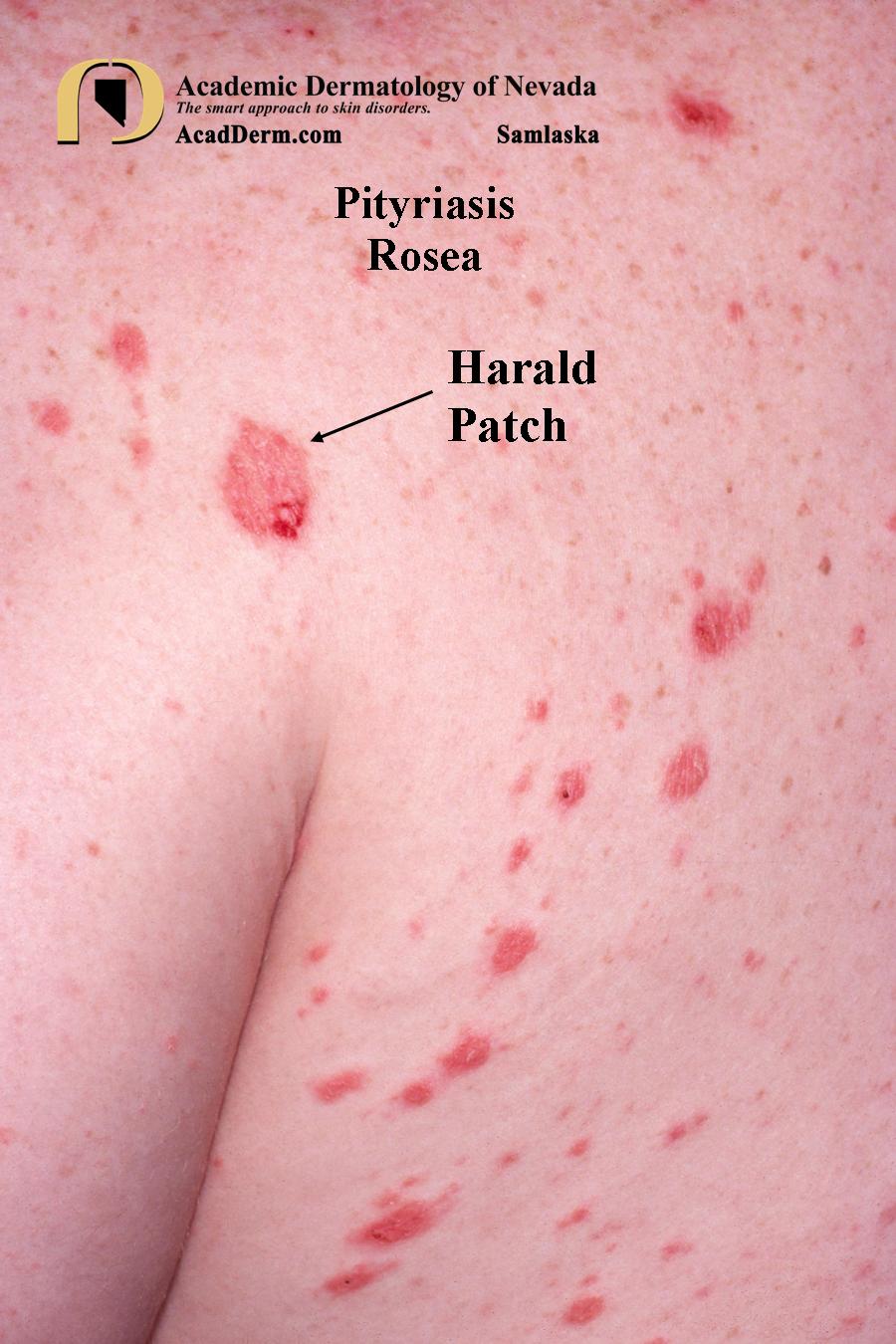 Pityriasis Rosea–It starts with a Herald Patch…
