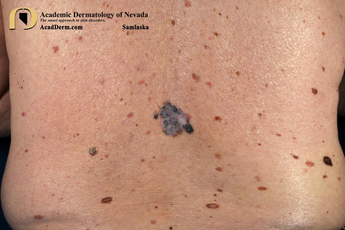 Regressive Melanoma