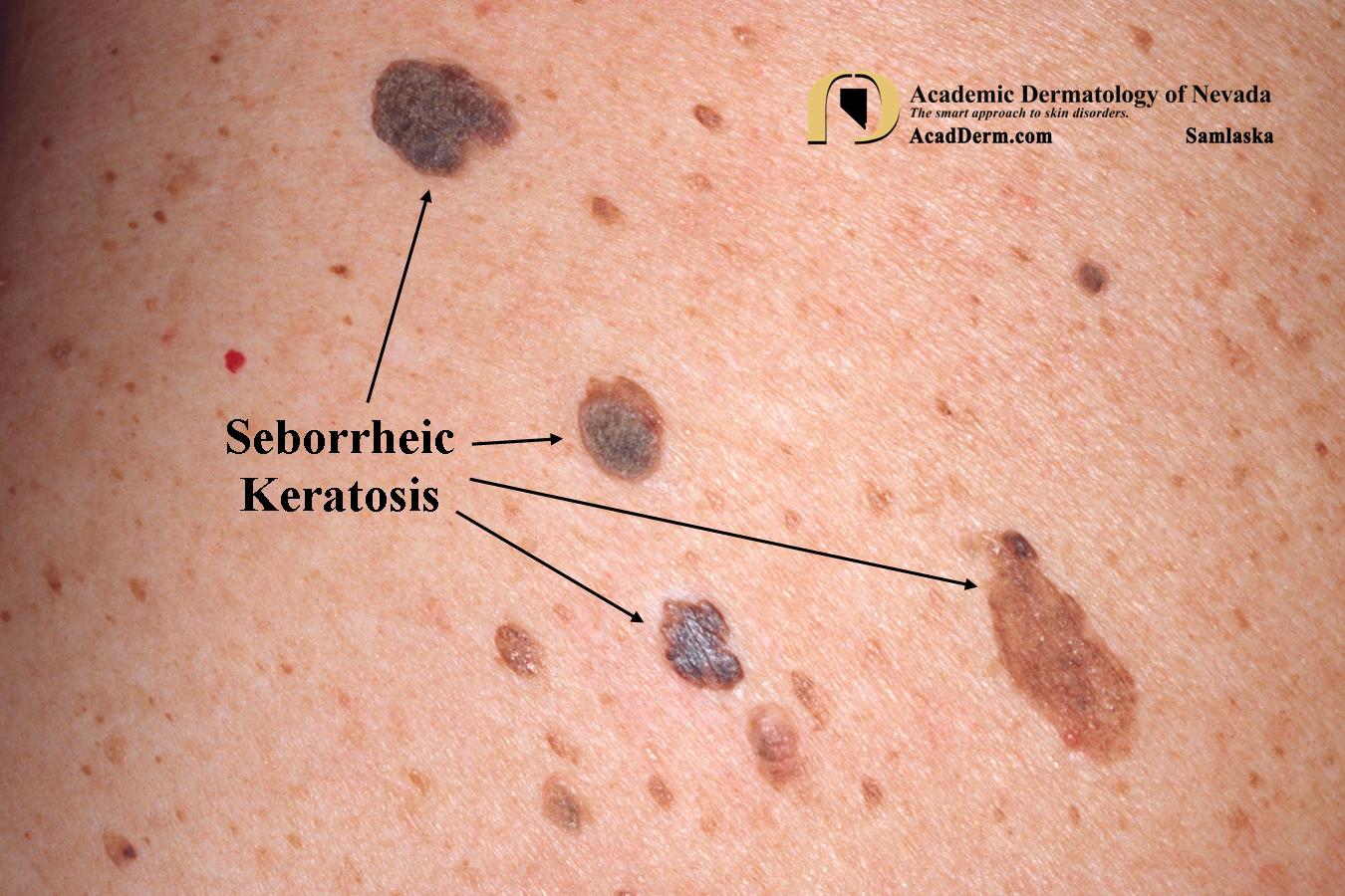 Seborrheic Keratosis:  Barnacles of life…