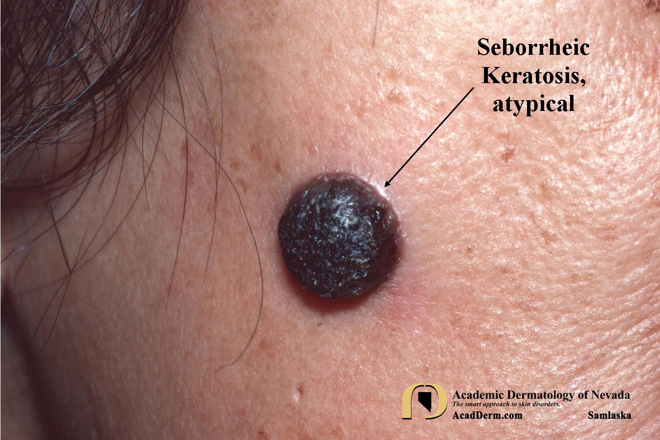 Seborrheic Keratosis:  Atypical Forms…