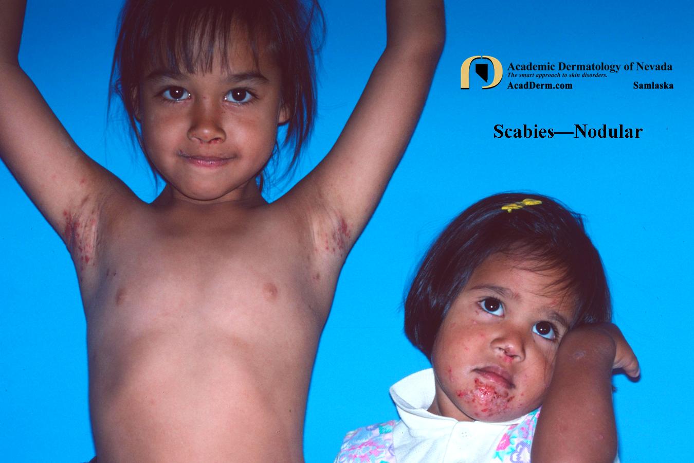 Parasitic Diseases:  Scabies