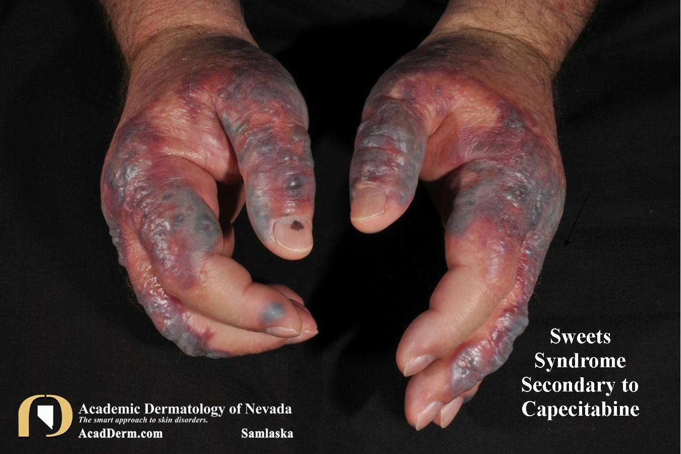 Drug Eruptions:  Capecitabine induced Sweet’s Syndrome