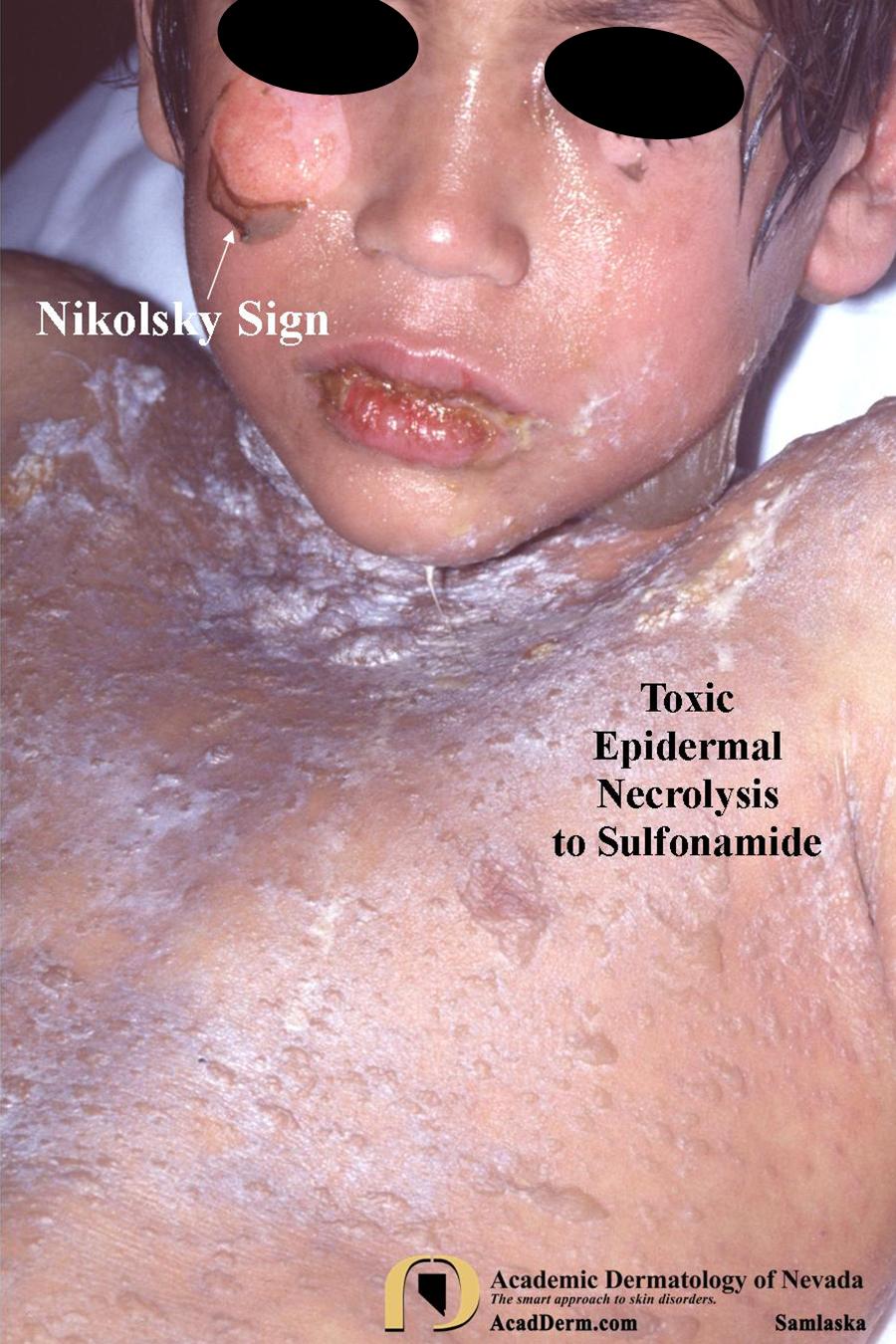 Drug Eruptions:  Toxic Epidermal Necrolysis (TEN)