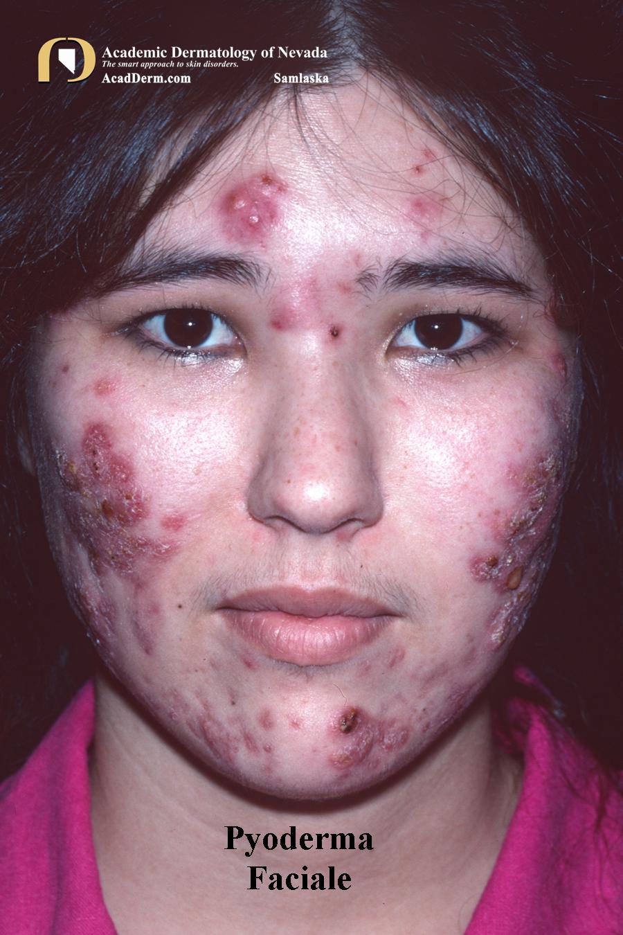 Complex Acne Disorders:  Pyoderma Faciale…