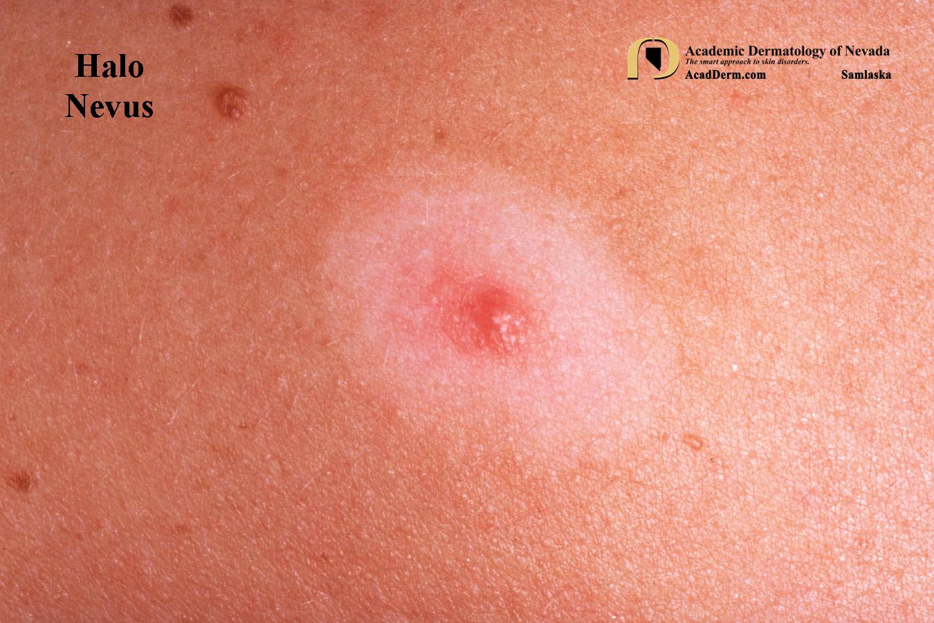 Halo Nevus:  Sutton Nevus…