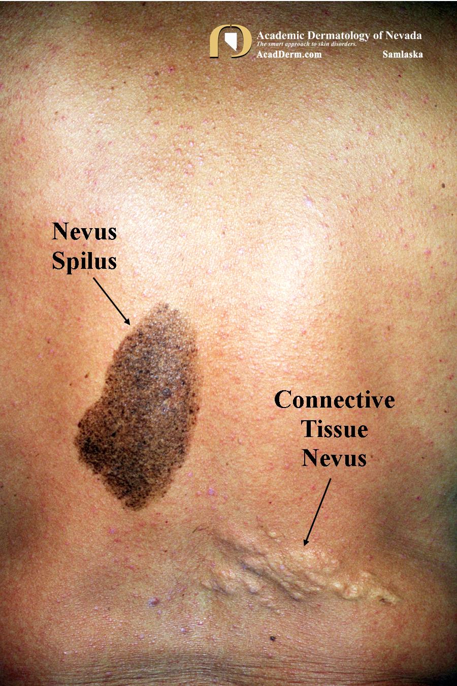 Nevus Spilus:  Speckled Lentiginous Nevus…