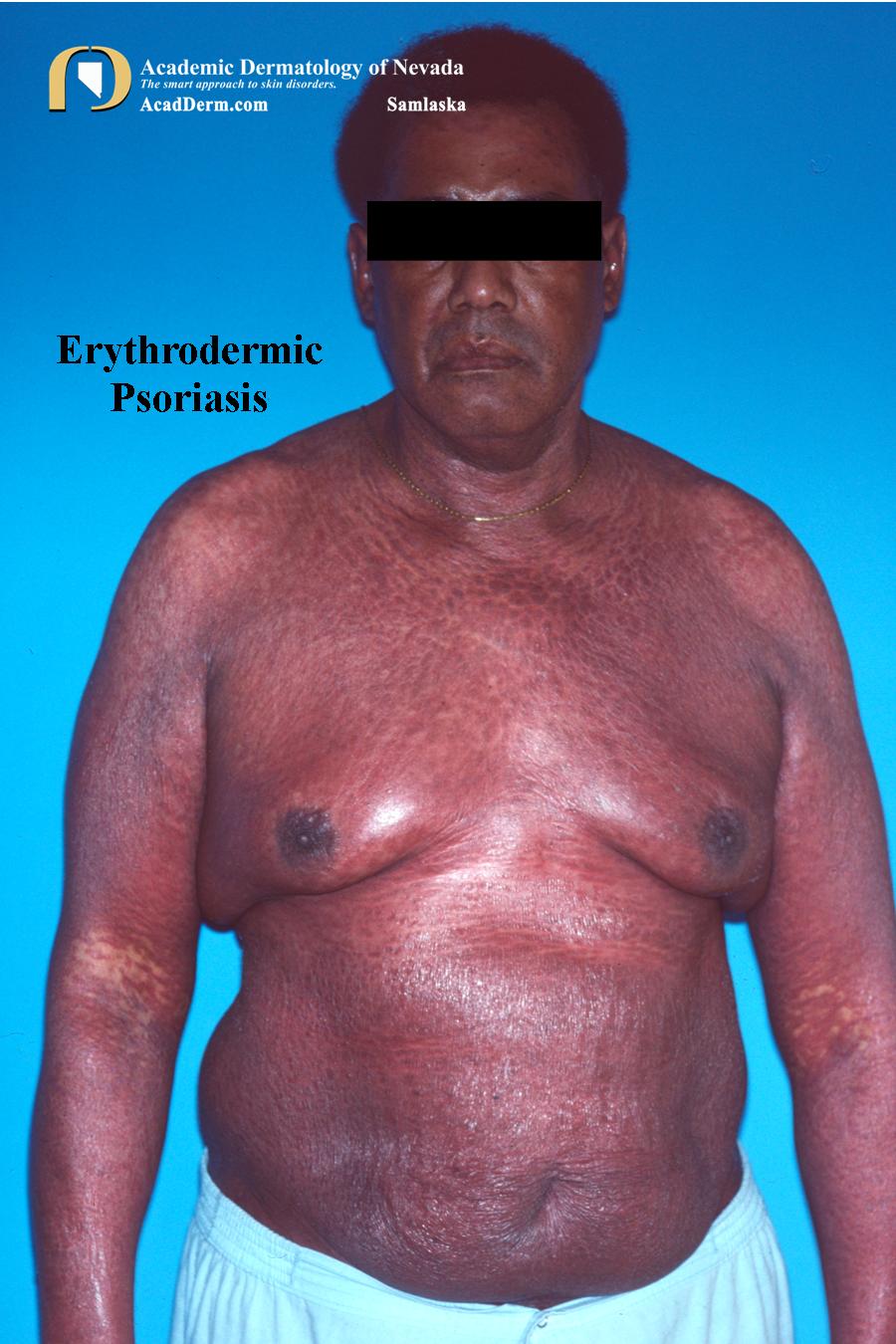 Erythrodermic Psoriasis:  An Exfoliative Dermatitis…