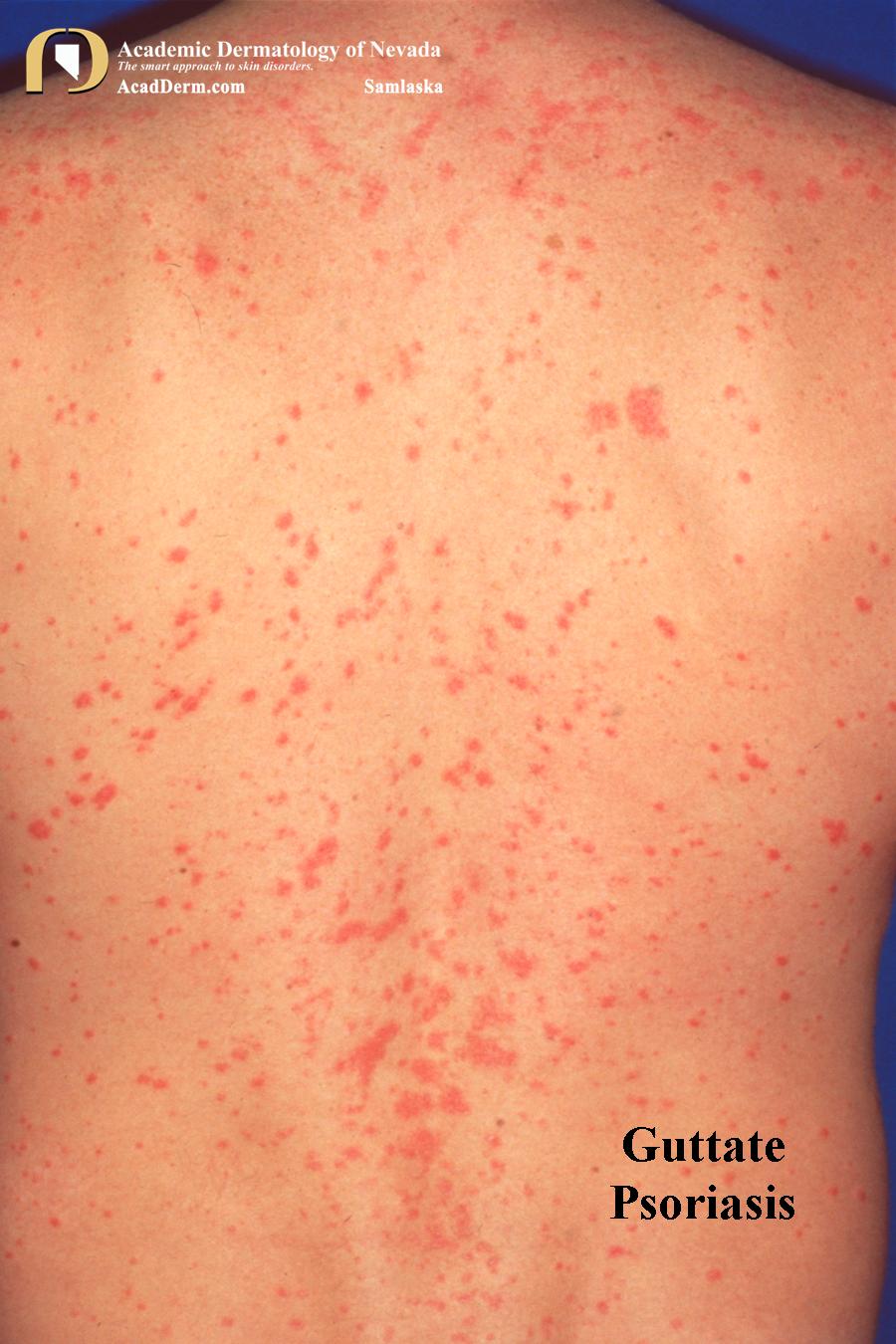 Guttate Psoriasis:  A Shower of Scaly Teardrops…