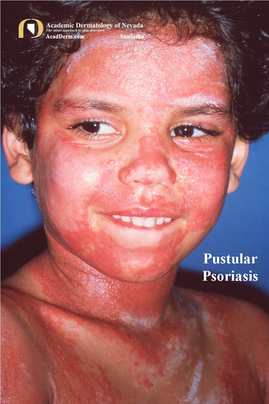 Pustular Psoriasis:  Lakes of Sterile Pustules…