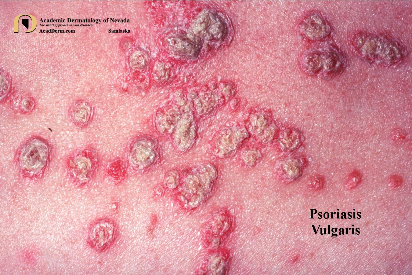 Psoriasis Vulgaris:  The Basics…