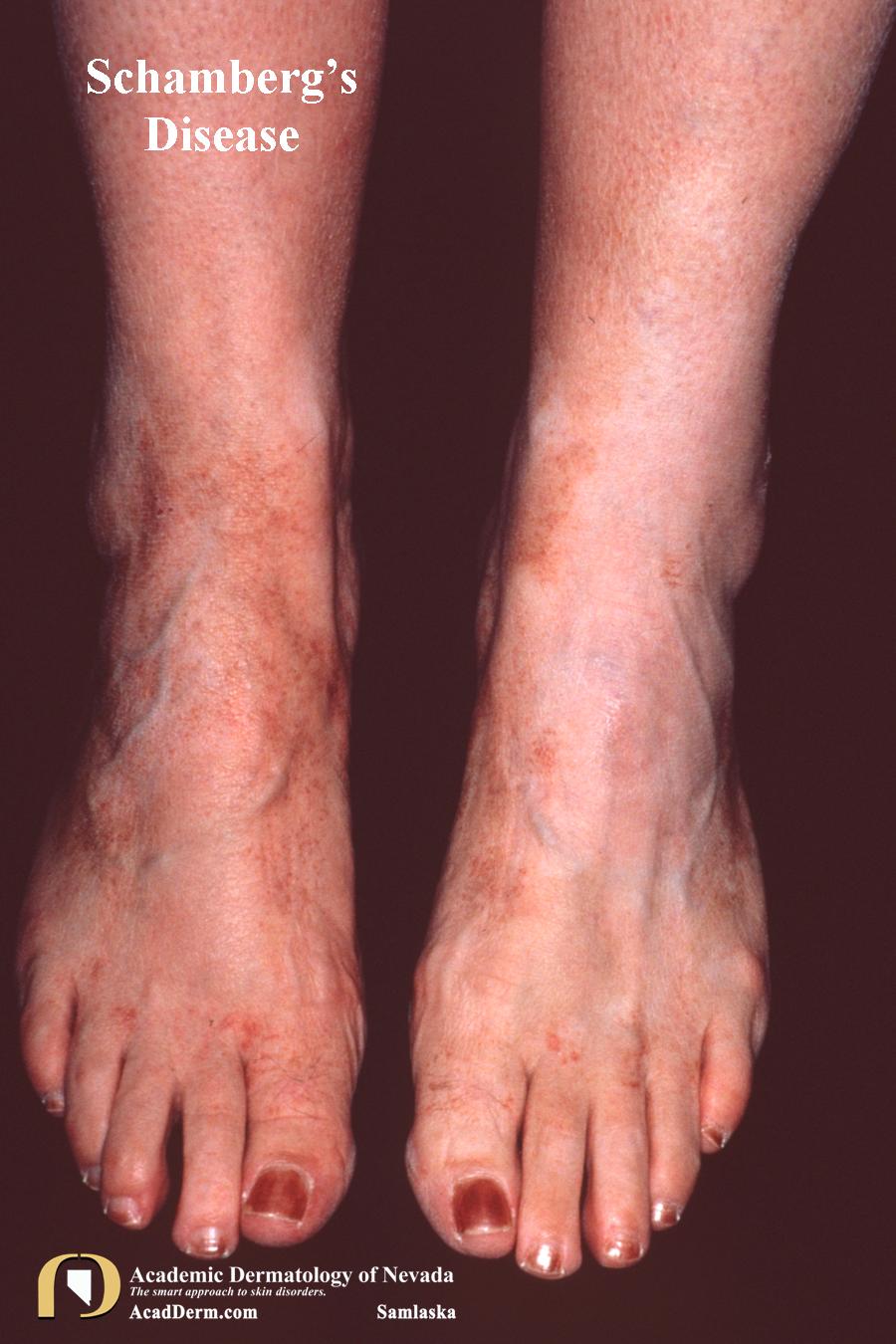 Schamberg’s Disease:  A Pigmentary Purpuric Eruption…