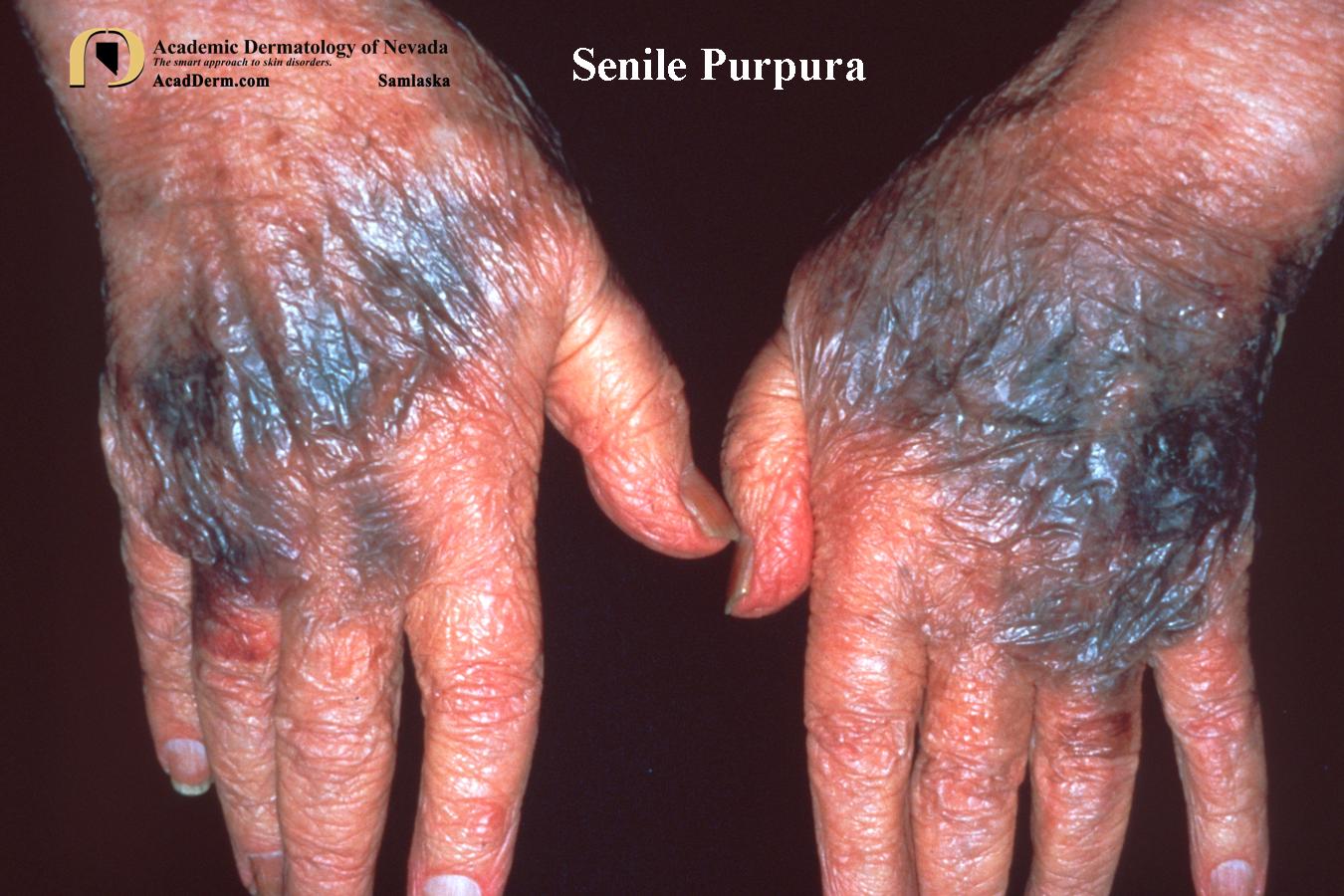 Senile Purpura:  Bruising In The Elderly…