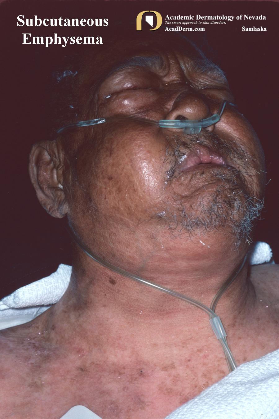 Subcutaneous Emphysema:  It’s a gas…gas…gas…