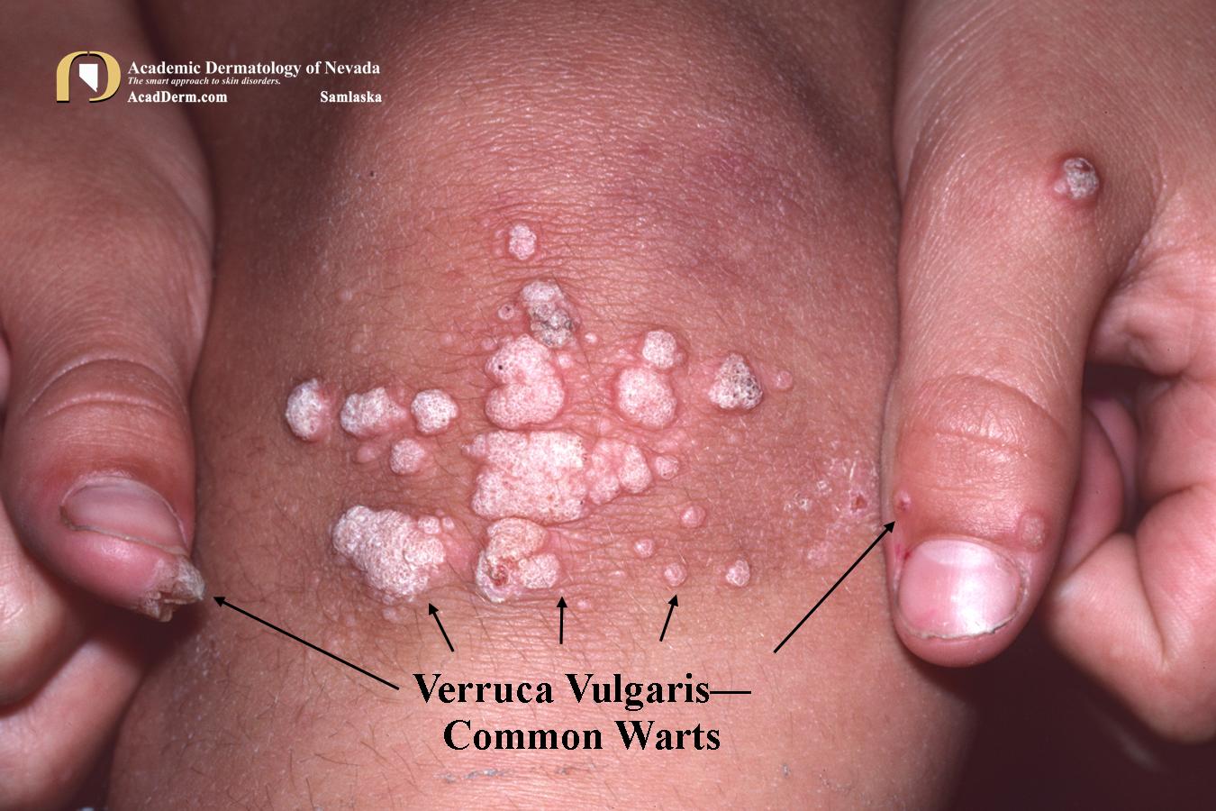 Warts (Verruca Vulgaris):  Common Type