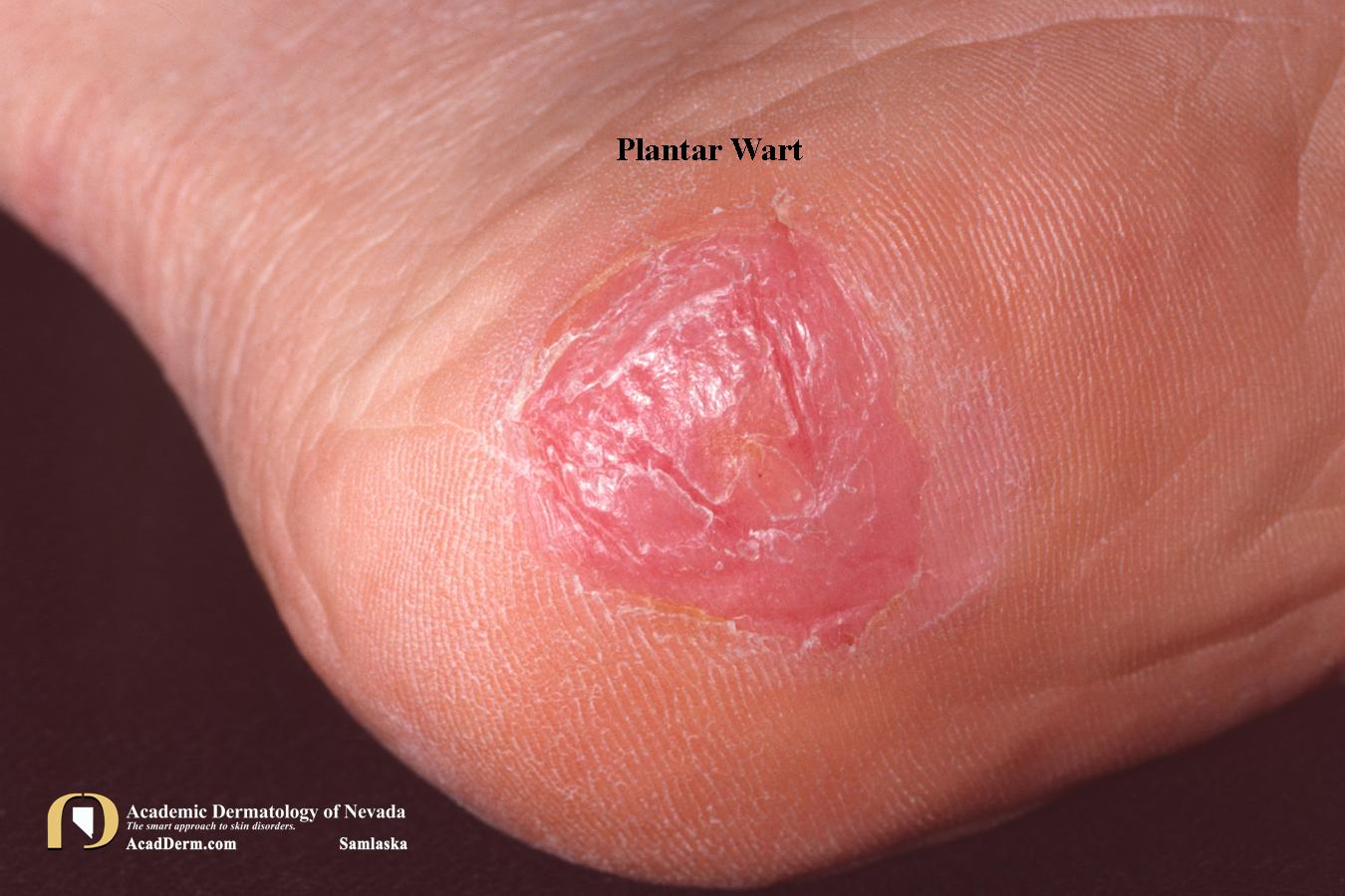 Plantar Warts (Verruca Plantaris):  Seed Warts?