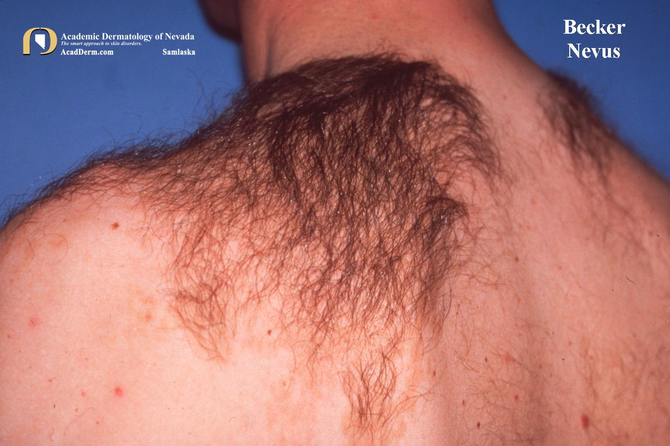 Becker Nevus:  A Manly Thing…