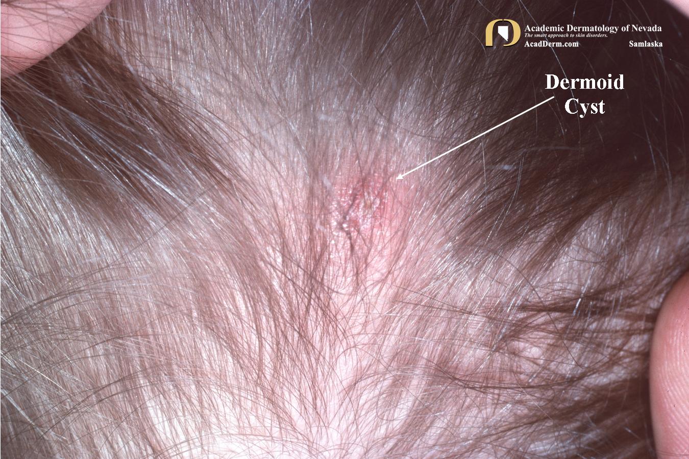 Dermoid Cysts:  Once Upon A Time…