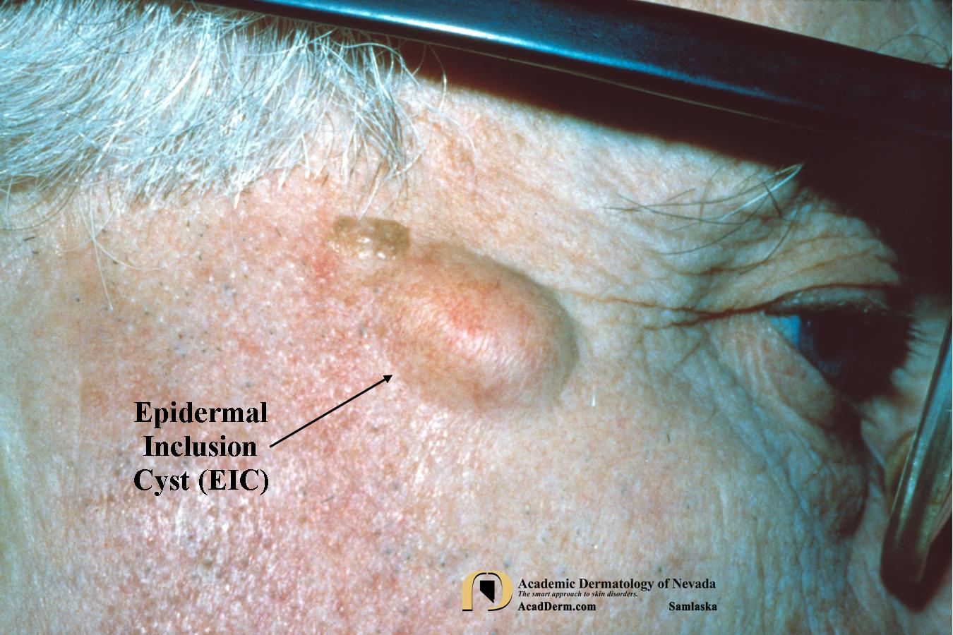 Epidermal Inclusion Cysts (EIC):  Epidermoid Cysts…