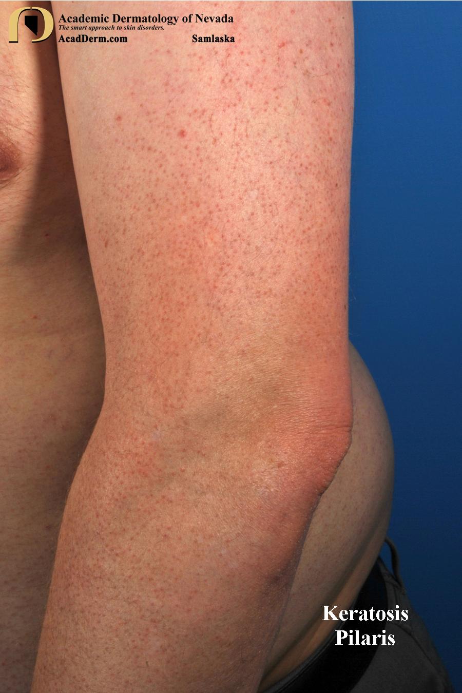 Keratosis Pilaris: It Feels Like Sandpaper…