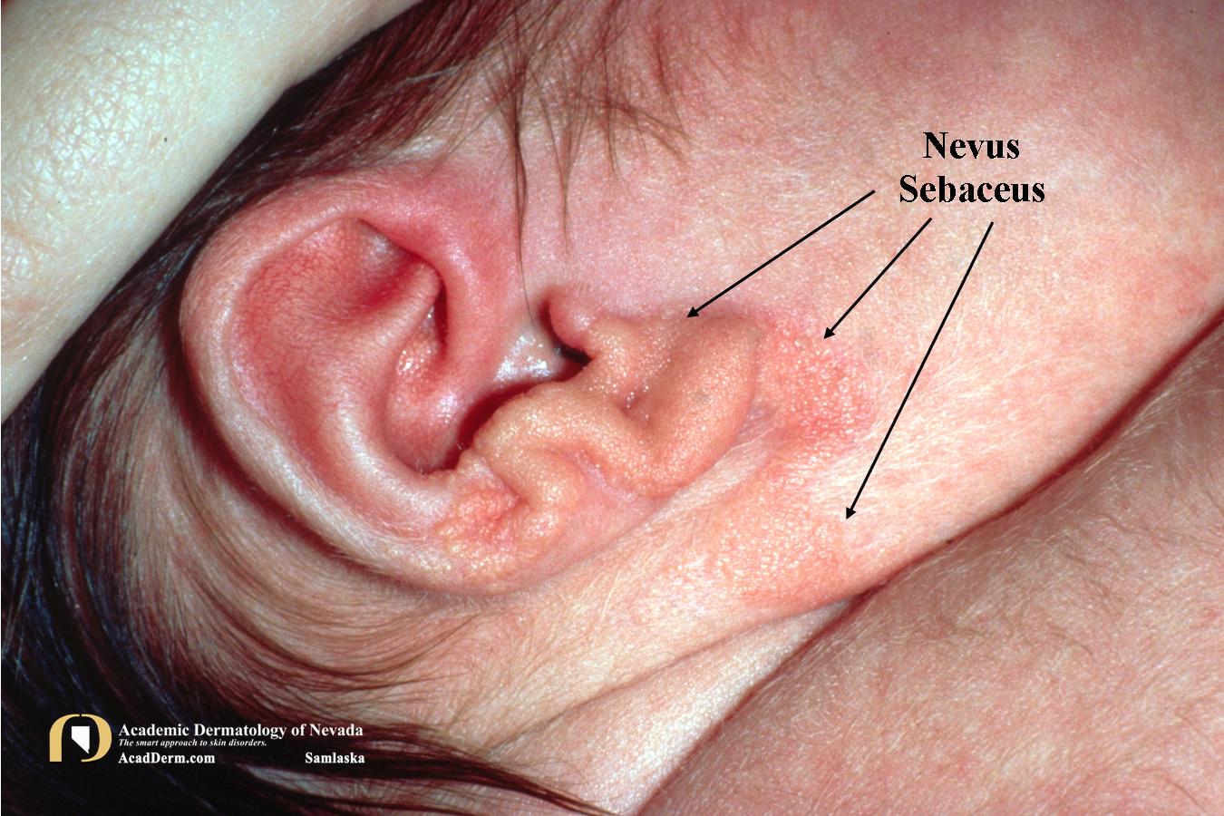 Nevus Sebaceus:  Of Jadassohn…