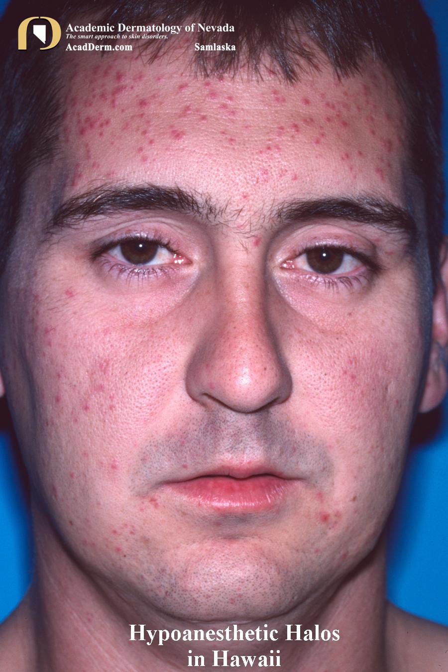 Hypoanesthetic Halos In Hawaii:  Invasion of the Thrips…