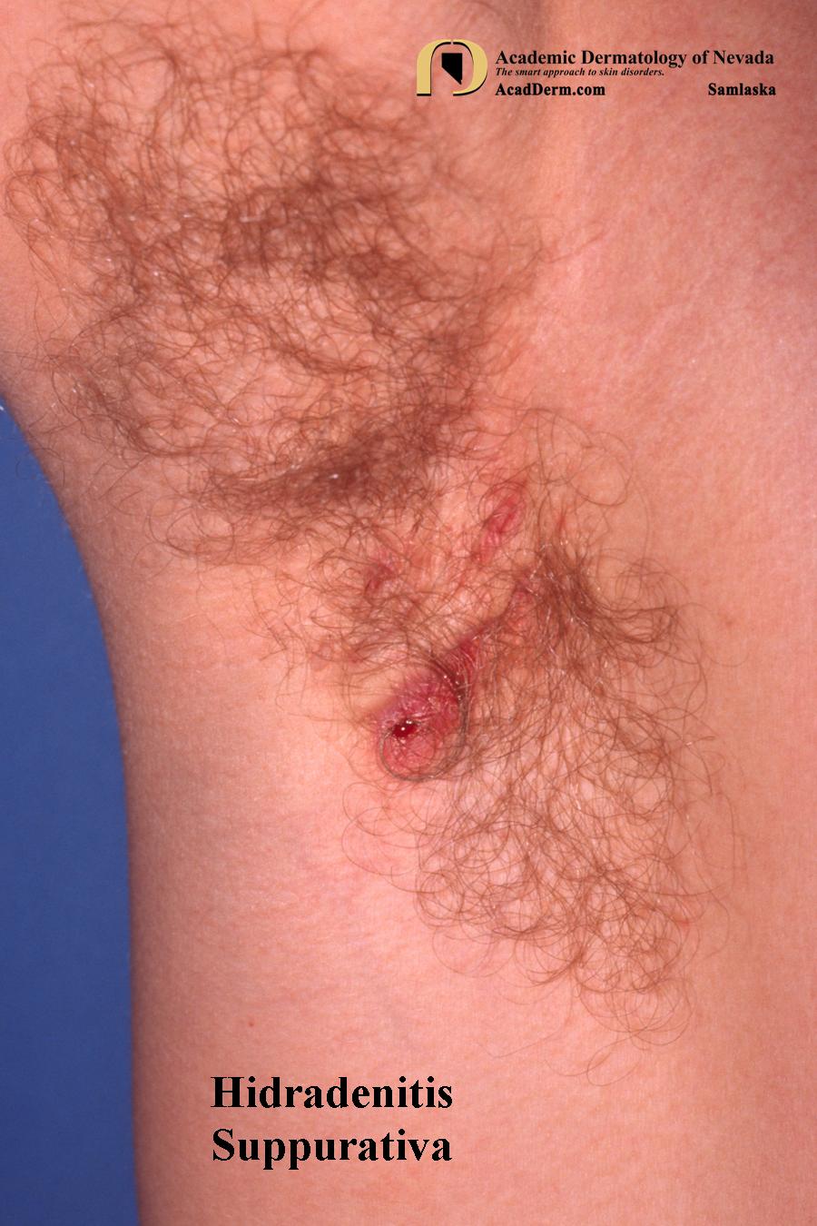 Hidradenitis Suppurativa:  Acne Inversa, Velpeau’s Disease…