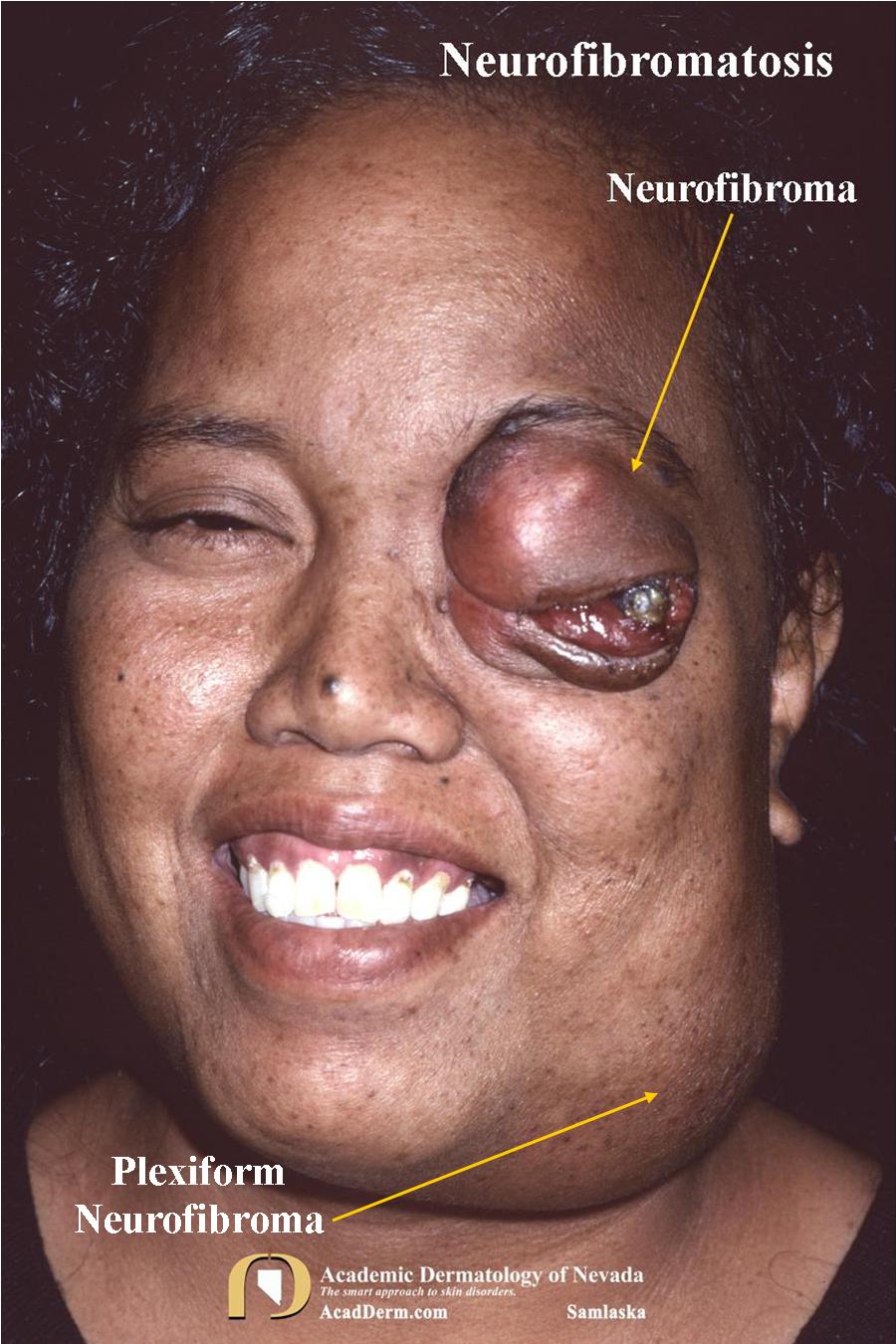 Neurofibromatosis 1:  Von Recklinghausen’s Disease…