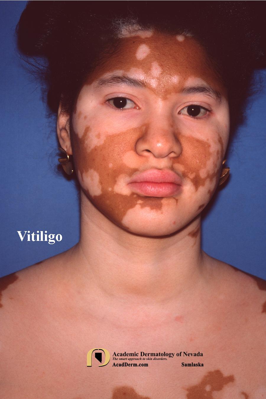 Vitiligo:  Leukoderma, Sins Against the Sun…