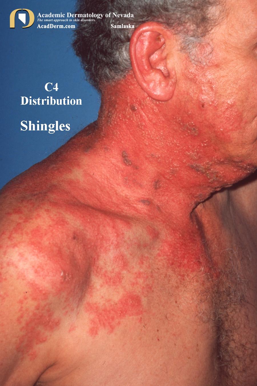 Shingles:  The Varicella-Zoster Connection…