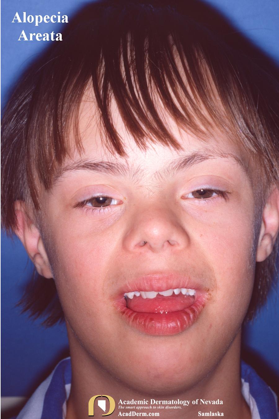 Alopecia Areata:  Autoimmune Alopecia…