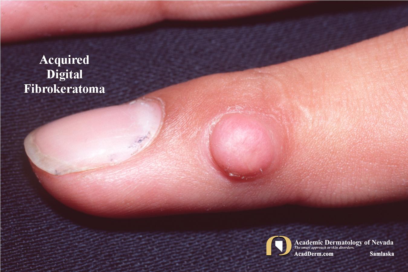 Acquired Digital Fibrokeratoma (ADFK):  Acral Fibrokeratoma…