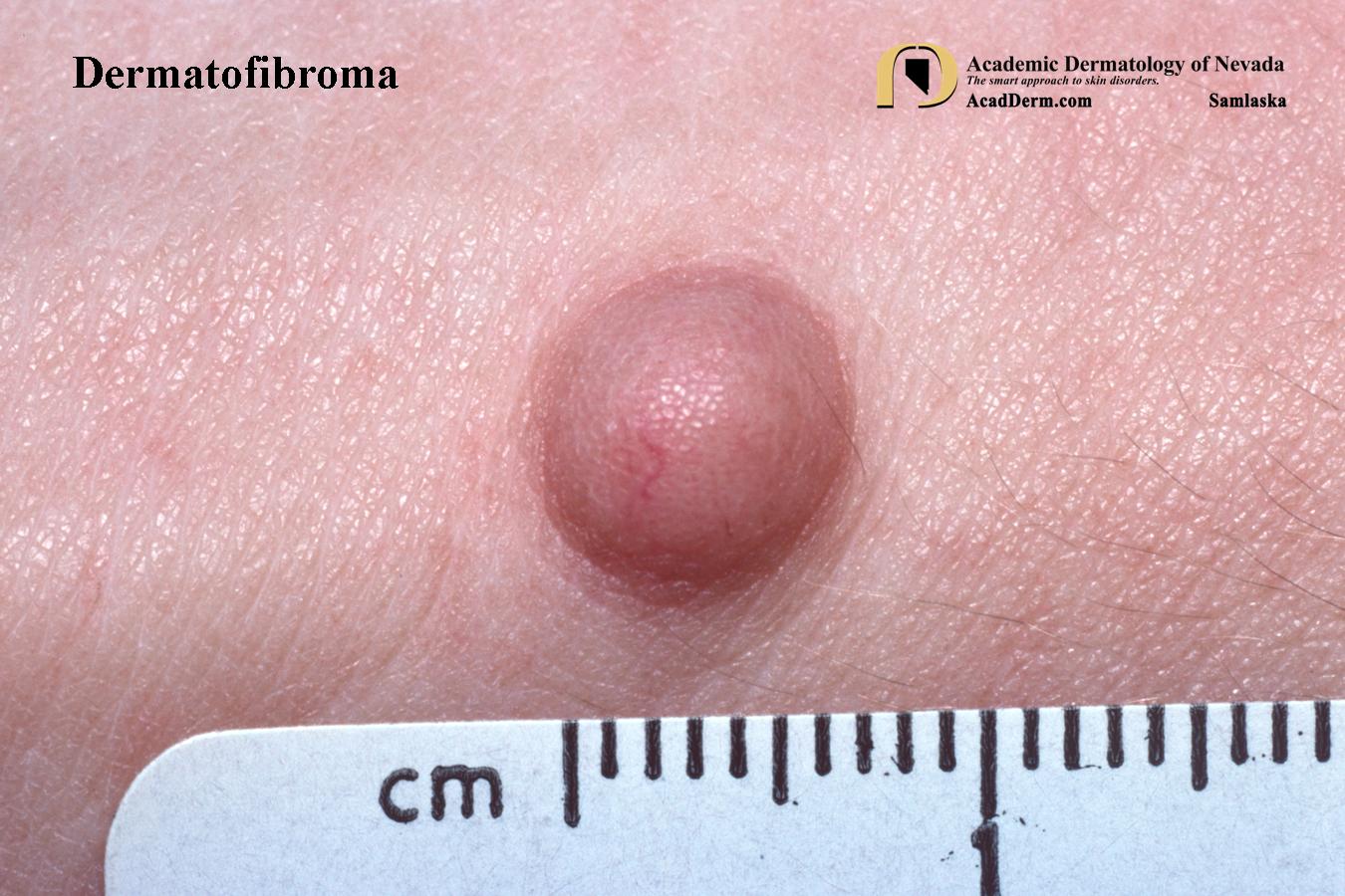 Dermatofibroma:  Benign Fibrous Histiocytoma…
